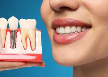 “It’s Very Expensive!” 7 Myths About Dental Implants