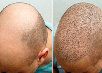 5 Debunked Myths About Hair Transplants