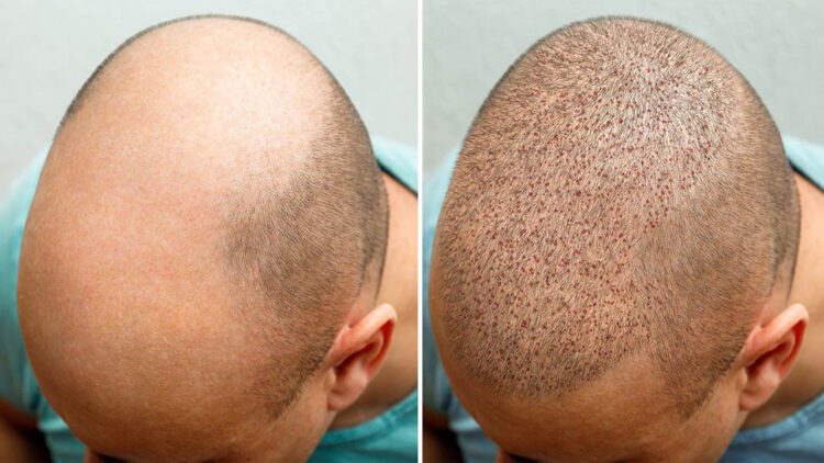 5 Debunked Myths About Hair Transplants